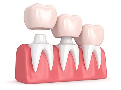Illustration Of Three Dental Crowns Above Tooth Roots On Gum Model Showing Is A Crown Falling Off A Dental Emergency Concept