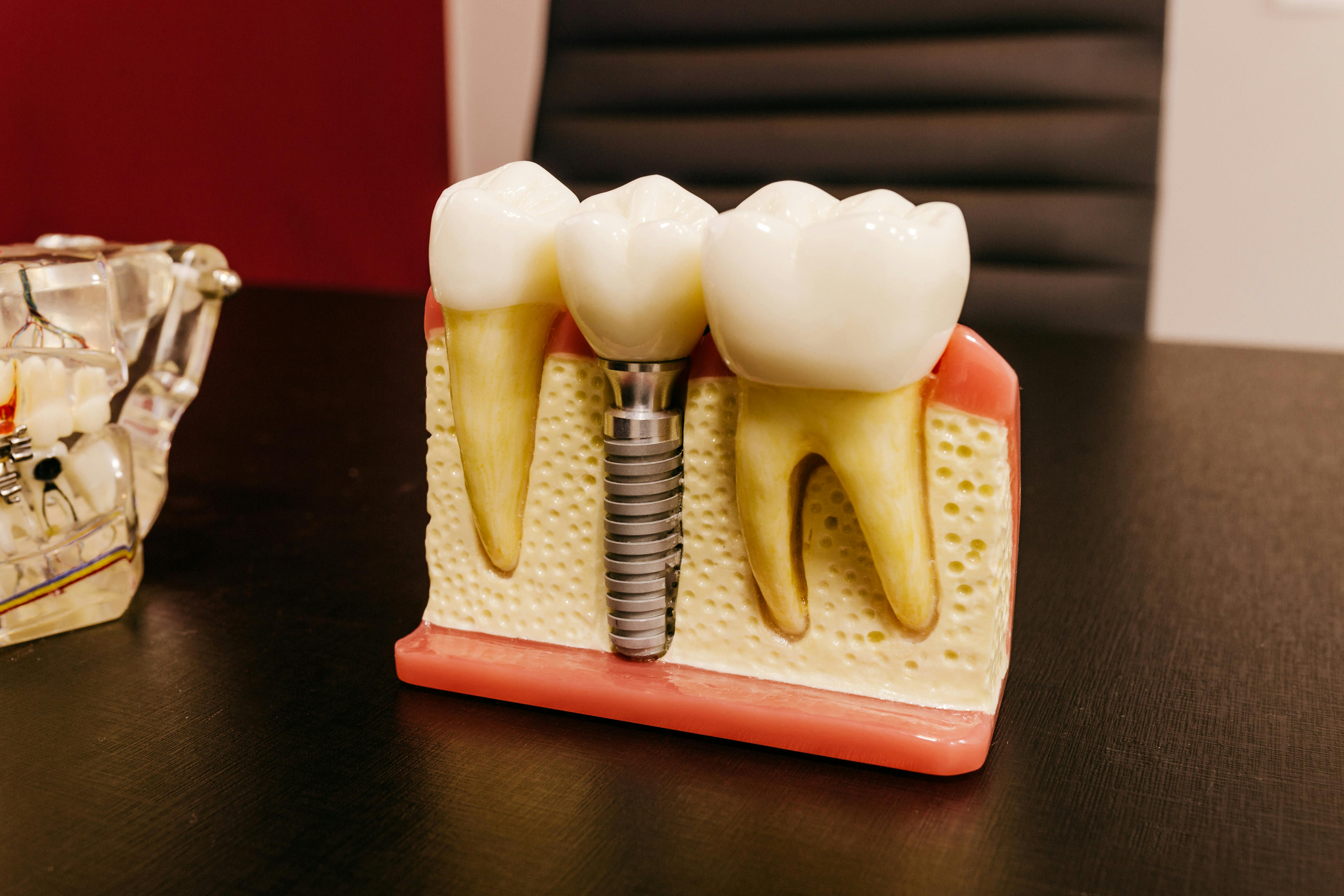 Photo Dental Implant Model Showing Metal Screw Post Between Two Natural Teeth On Gum Model