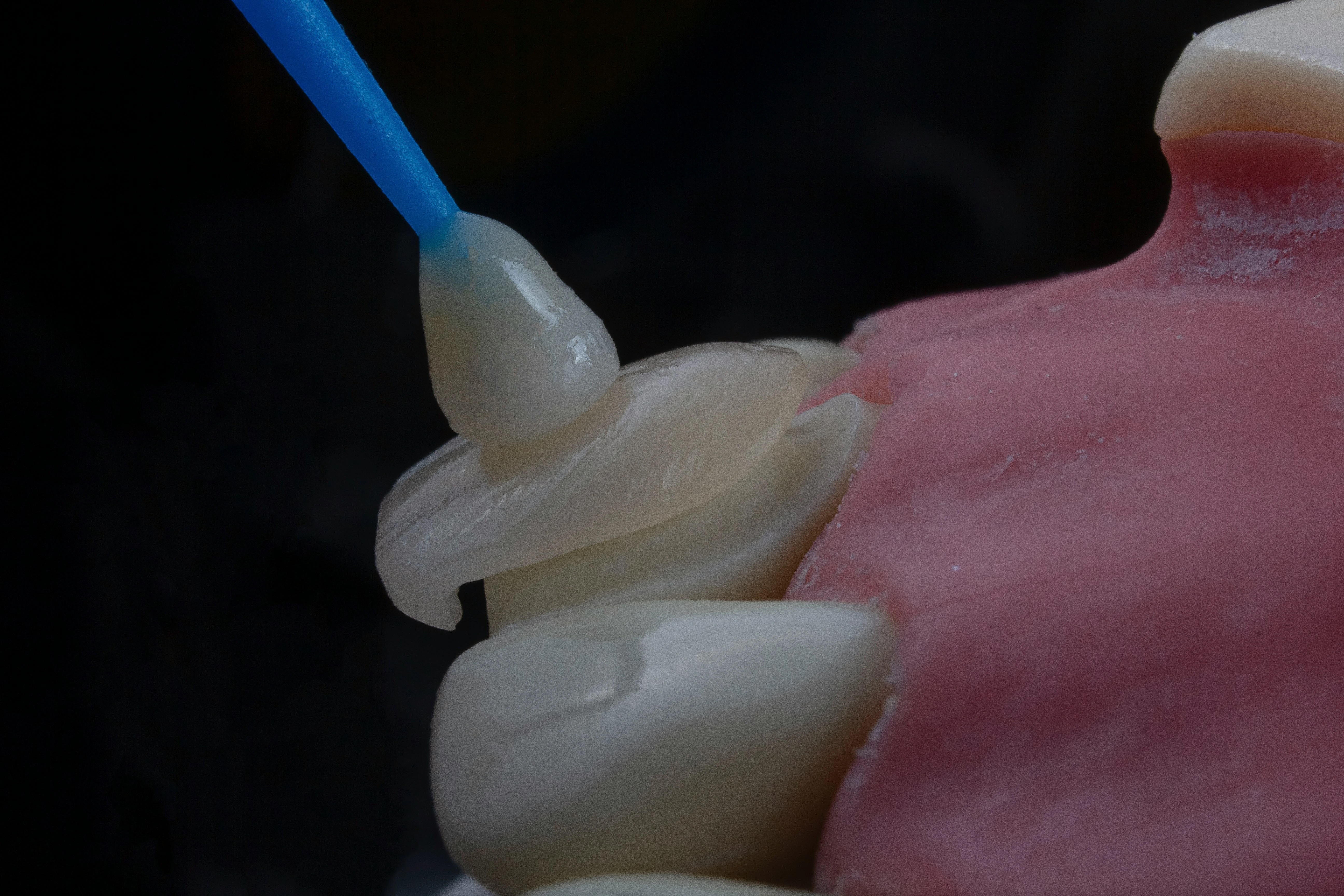 Photo Porcelain Veneer Placed On Tooth Bonding Process