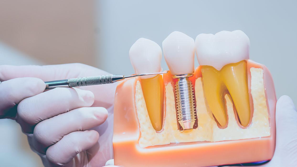 Photo Dental Implant Jaw Model Titanium Post Abutment Crown