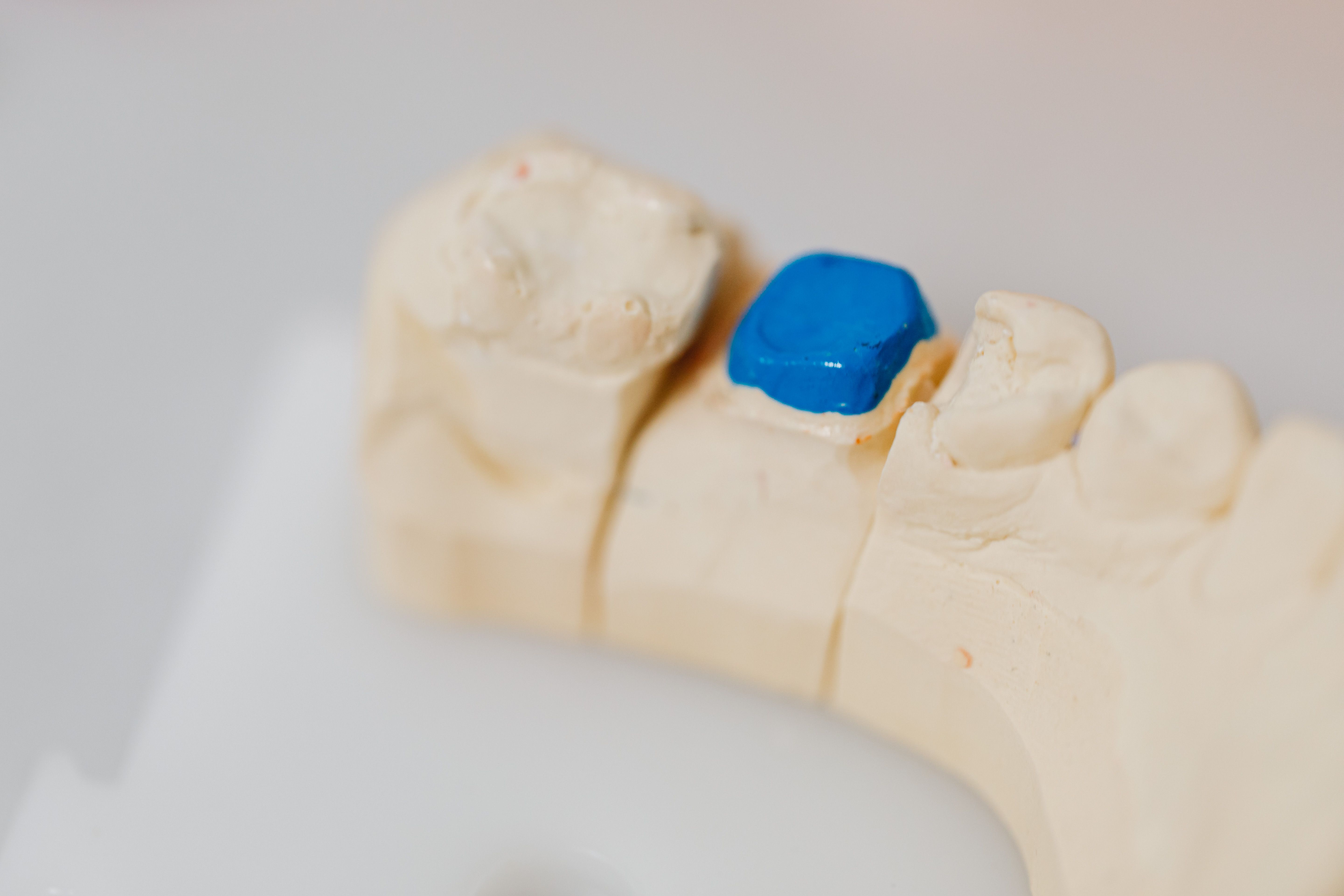 Photo Dental Model With Blue Crown Preparation Is A Broken Crown A Dental Emergency