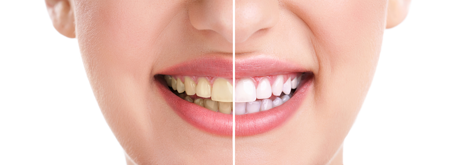 Photo Smile Before After Teeth Whitening Comparison