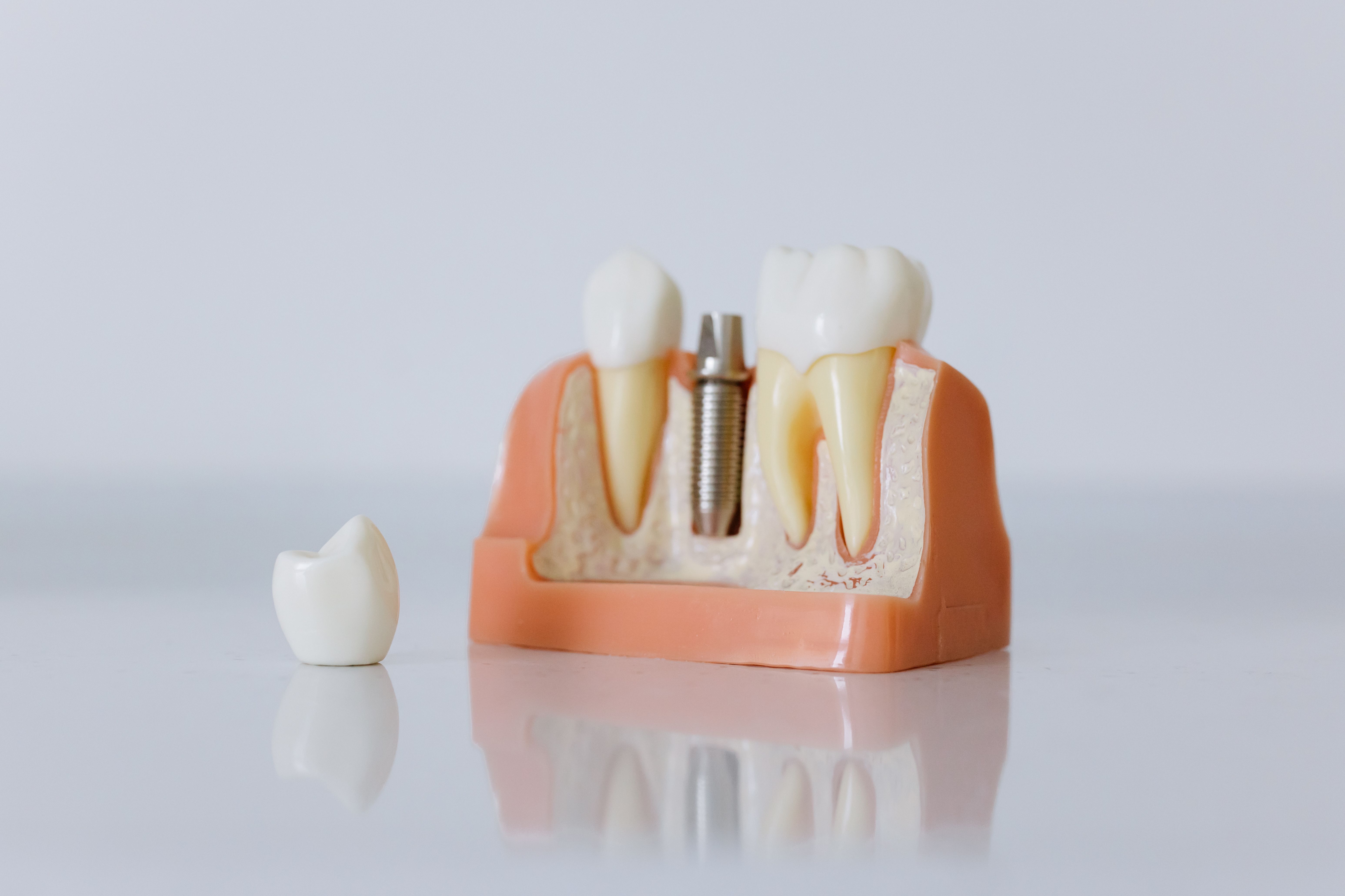 Photo Dental Implant Model With Separate Crown Display