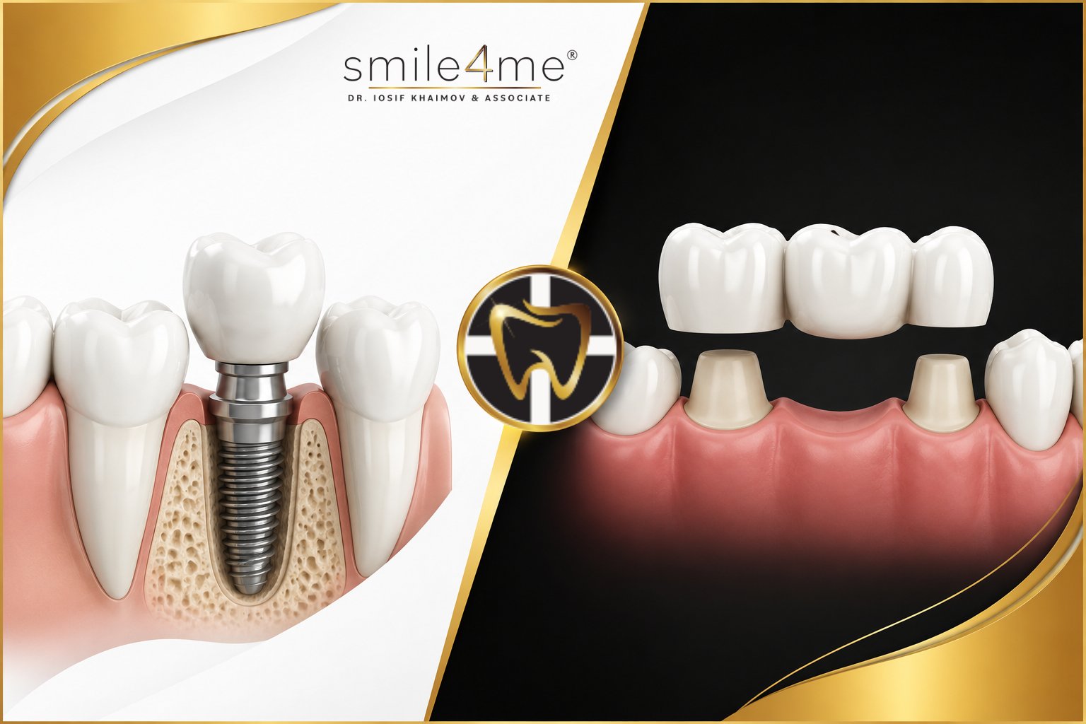 Illustration Dental Implant Vs Bridge Comparing Single Implant And Three Tooth Dental Bridge