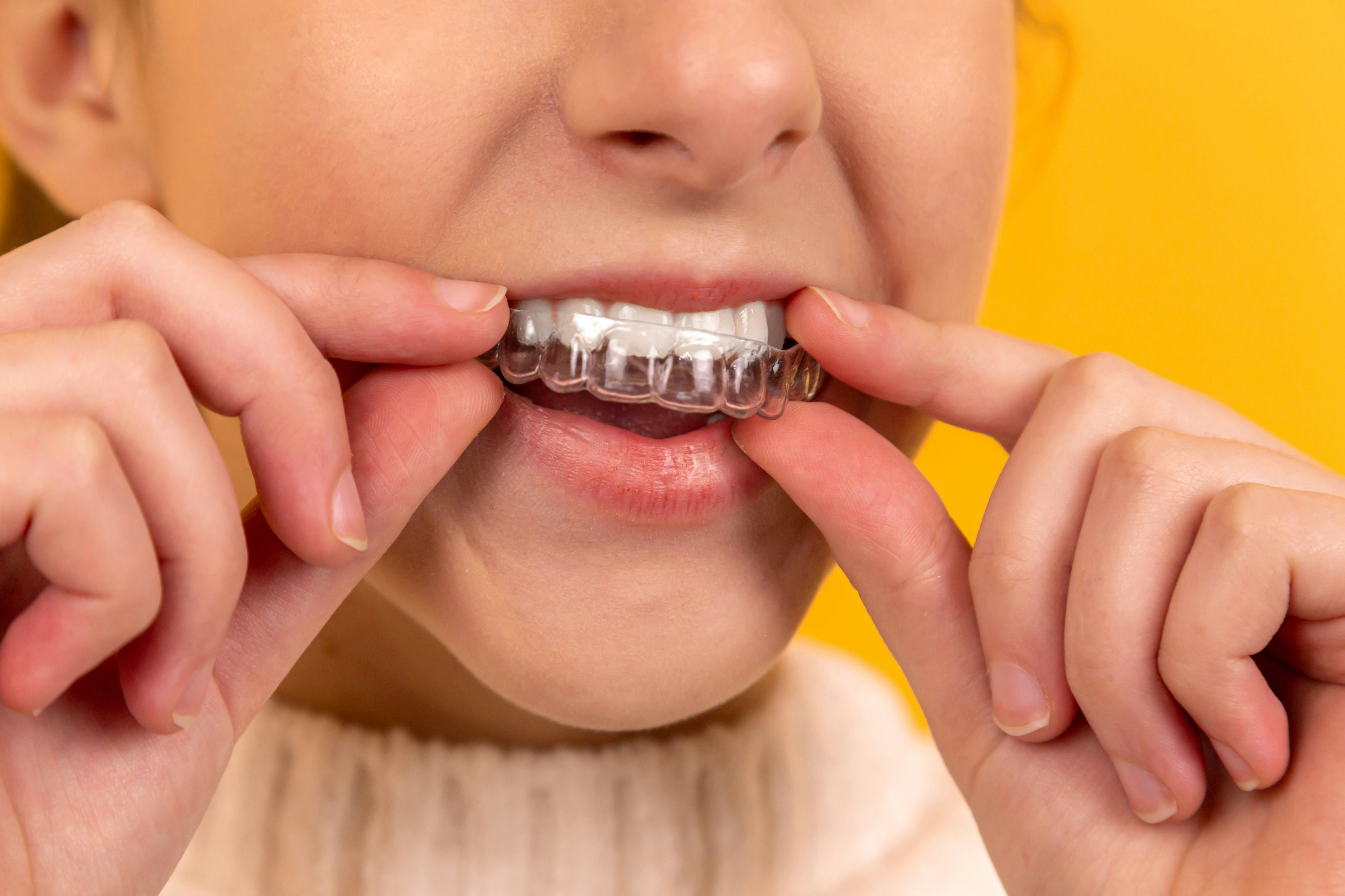 Photo Close Up Putting On Clear Invisalign Aligner On Teeth