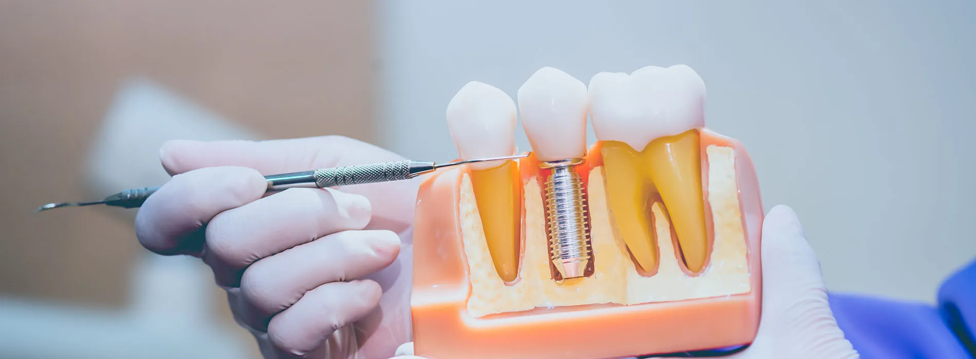 Photo Of Anatomical Model Showing Dental Implant Screw Post