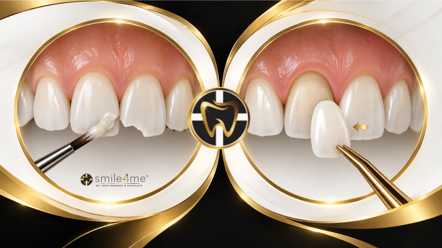 Graphic Bonding Vs Veneers Comparison Showing Tooth Repair And Veneer Placement