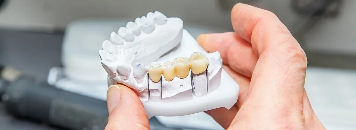 Hand Holding Dental Bridge Model Showing Replacement Teeth Attached To Crowns On A White Cast