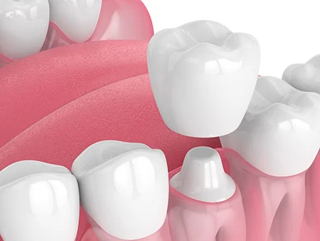 3d Render Of Dental Crown Being Placed Over Prepared Tooth Highlighting Difference Between Veneers And Crowns In Full Tooth Coverage Vs Front Surface