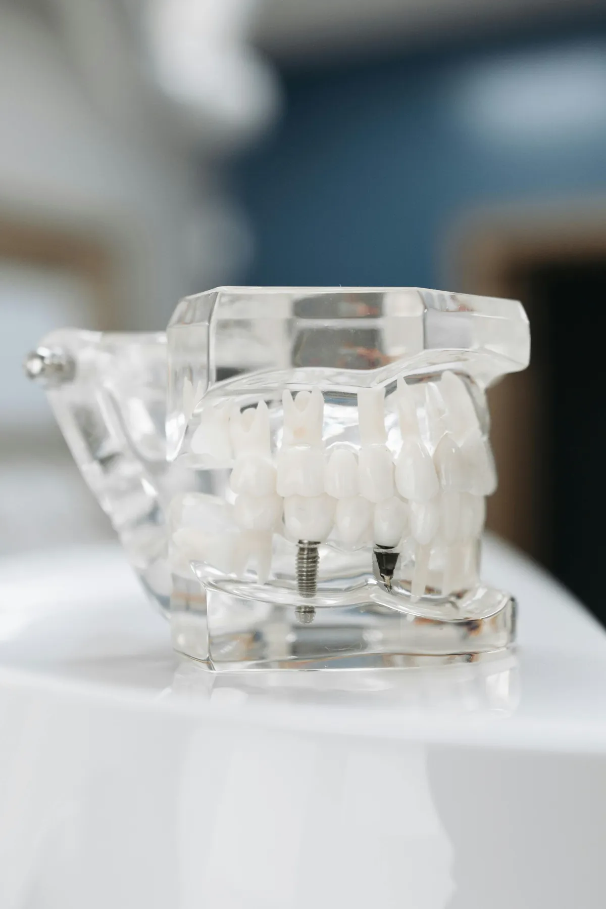 Clear Dental Model Showing Teeth And Metal Implants In A Clinic Setting