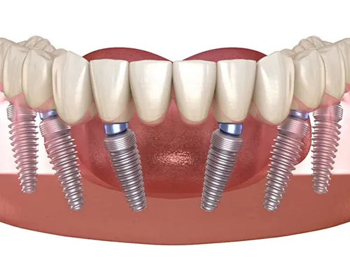 Illustration Showing Lower Jaw With Six Dental Implants Supporting A Full Set Of Artificial Teeth