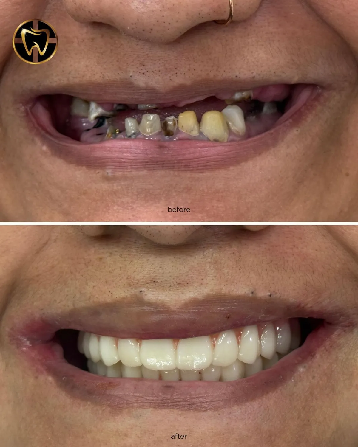 What Are Mini Dental Implants